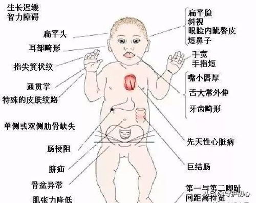 是一位母亲生下唐氏综合征患儿背后的故事
