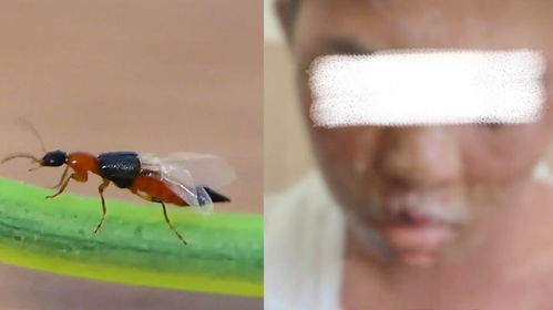 男孩拍打隐翅虫后用错药物全身溃烂，病因何在？