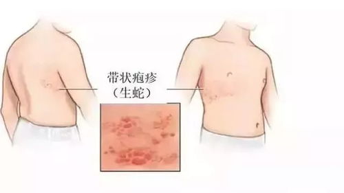 专家解读，带状疱疹痛多见于慢性病患者