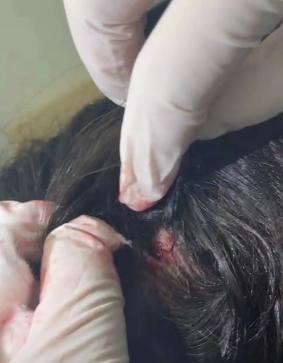 女孩因输头孢过敏擅自拔针不幸身亡