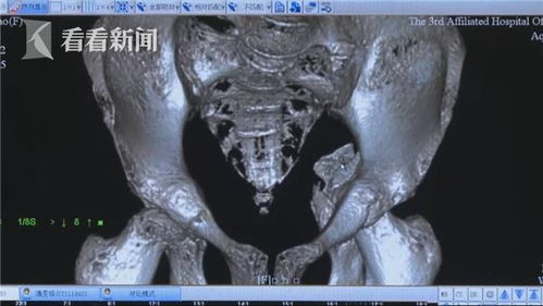 女性长期皮下注射激素导致骨坏死