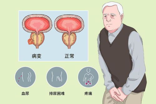 前列腺癌的早期症状及其重要性